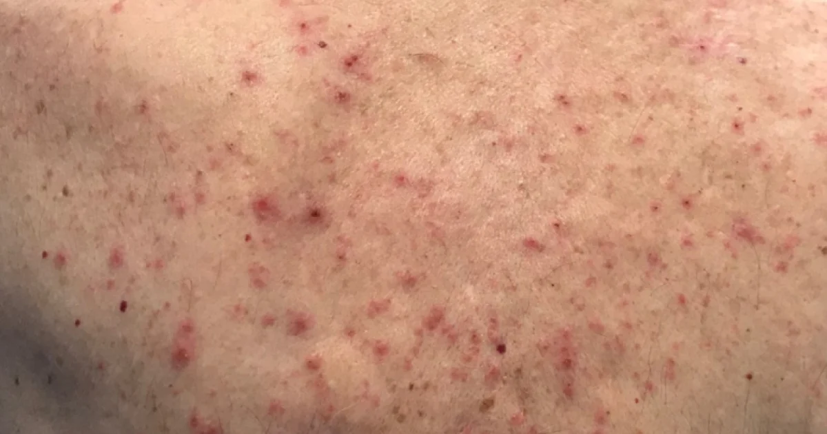 Canada oo oo laga helay  kiisas cusub oo busbus Daayeerada ah